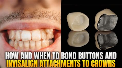 can you bond brackets to metal crowns|bonding buttons with crowns.